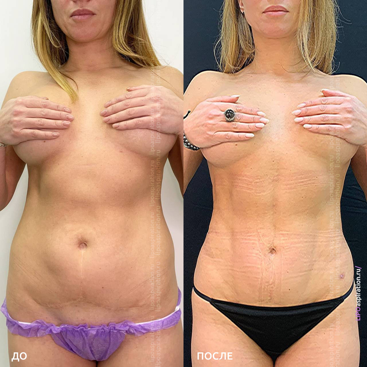 липосакции груди у женщин фото 30